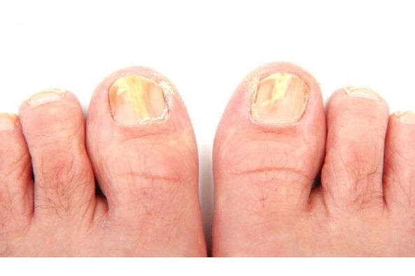 mycose des ongles due à une infection par des dermatophytes
