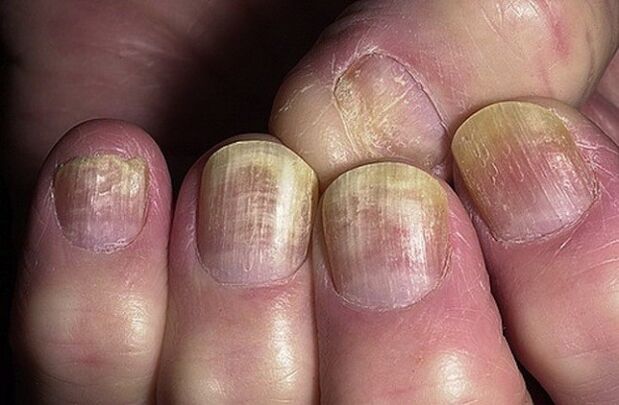 ongles infectés par le champignon Candida